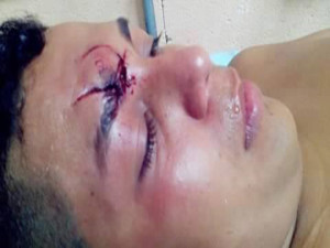 Este joven de quien no se preciso su nombre, resultó con fracturas en su rostro y fue trasladado al Hospital Escuela Universitario (HEU)