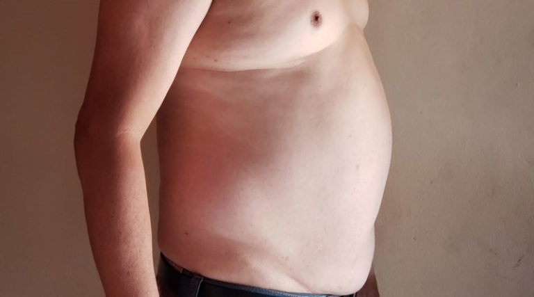 Obesidad alcanza niveles epidémicos